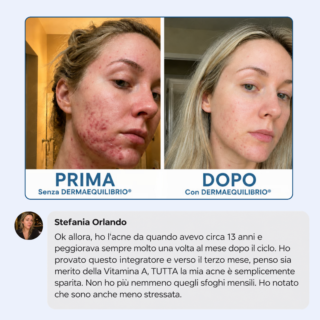Di' addio ad acne e brufoli, e torna a sentirti finalmente sicura di te
