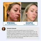 Di' addio ad acne e brufoli, e torna a sentirti finalmente sicura di te