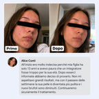 Di' addio ad acne e brufoli, e torna a sentirti finalmente sicura di te