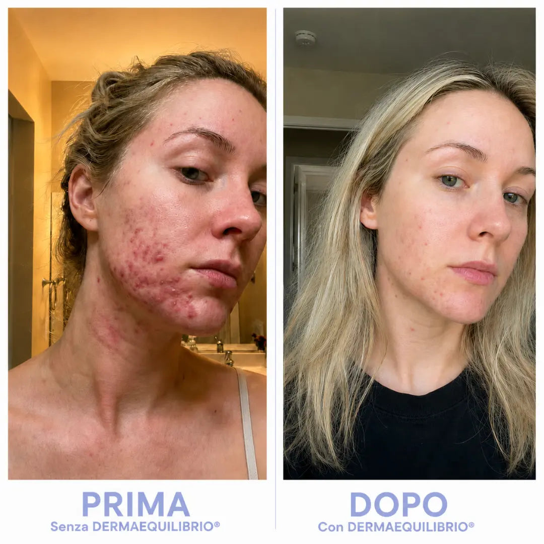 Di' addio a brufoli e acne, e torna a sentirti finalmente sicura di te