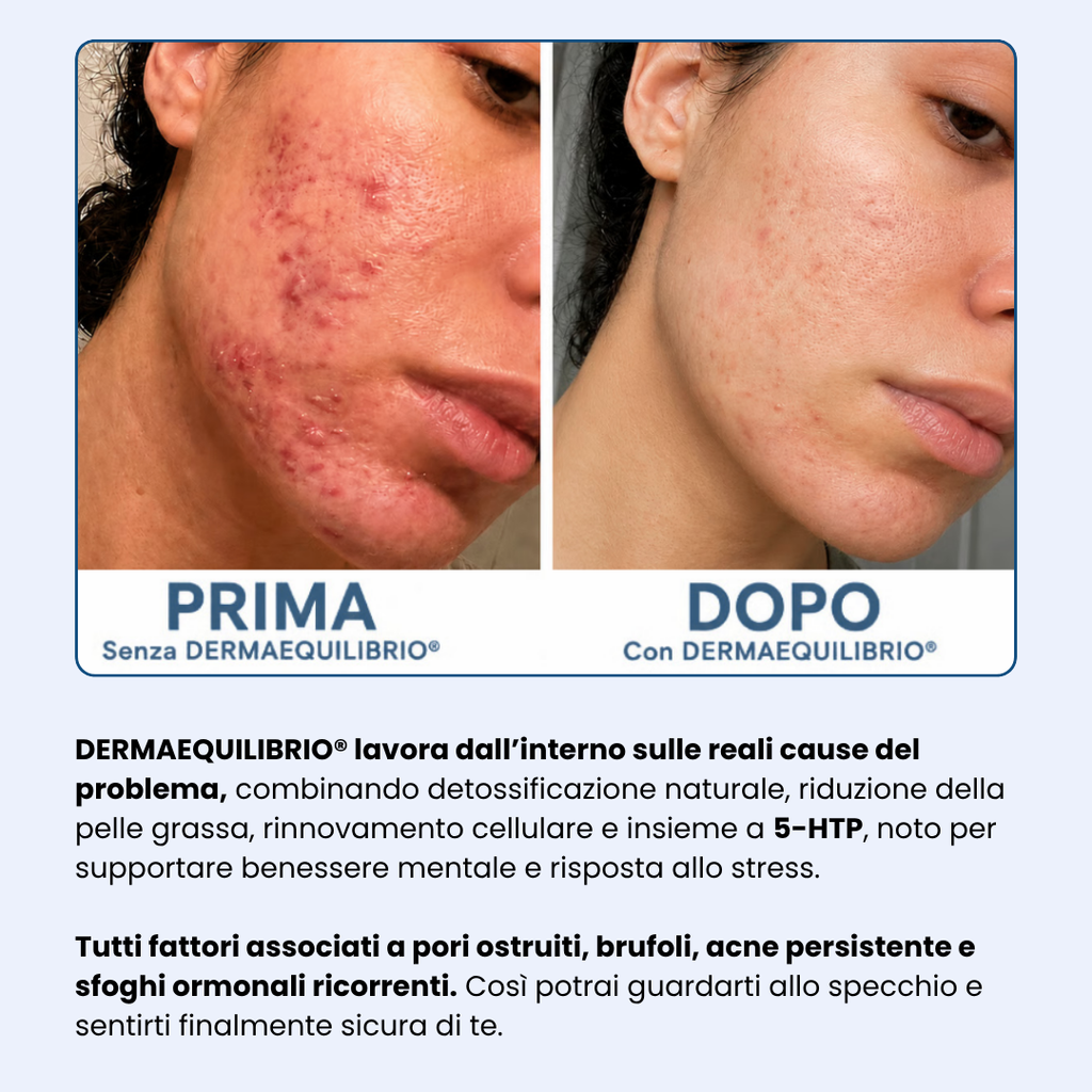 Di' addio ad acne e brufoli, e torna a sentirti finalmente sicura di te