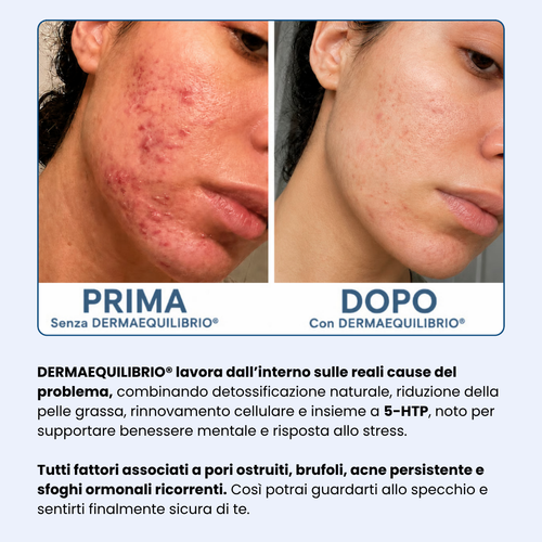 Di' addio ad acne e brufoli, e torna a sentirti finalmente sicura di te