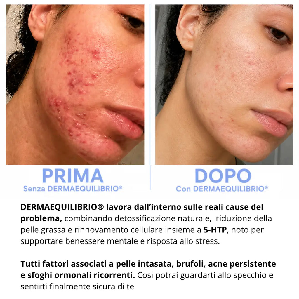 Di' addio a brufoli e acne, e torna a sentirti finalmente sicura di te